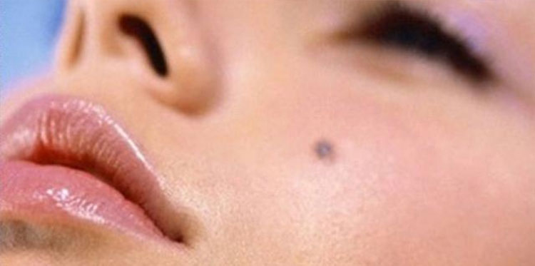 Ученые узнали, что означает большое количество родинок