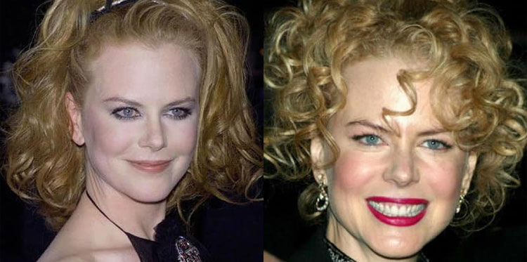 Николь Кидман наконец-то призналась, что колола ботокс