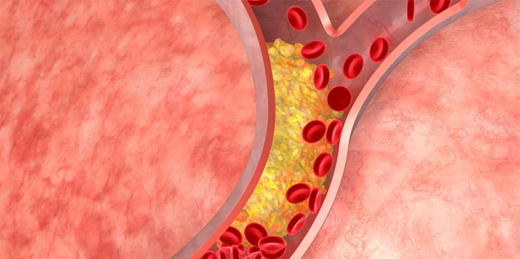 Гиперлипидемия – нарушение жирового равновесия