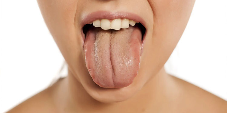 Желтый налет на языке