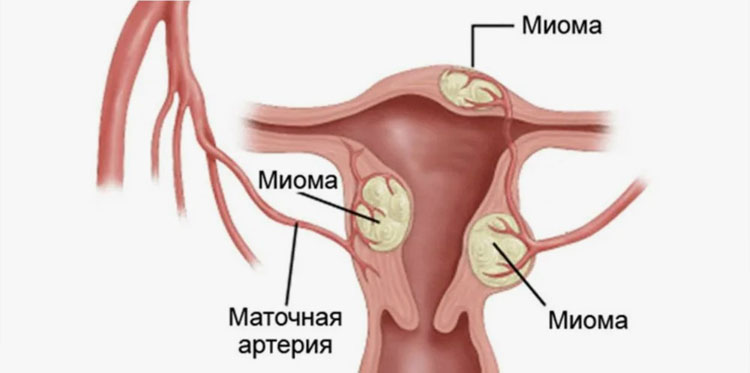 Миома матки - симптомы и лечение