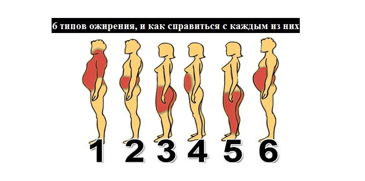 6 типов ожирения: как справиться с каждым из них?