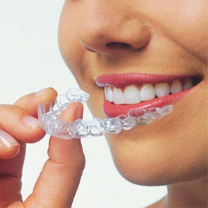 Каппы Invisalign