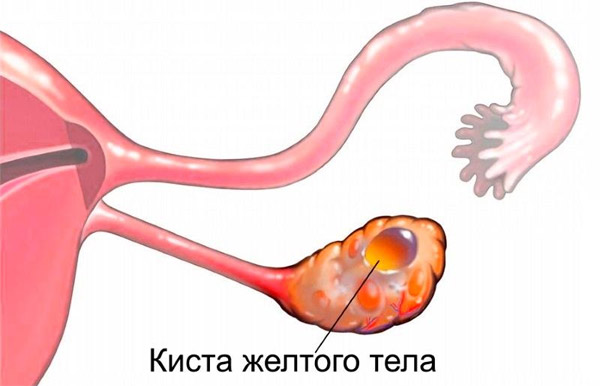 Киста желтого тела яичника