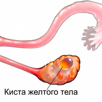 Киста желтого тела яичника