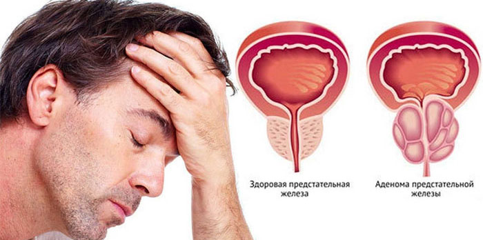 Чем лечить аденому простаты