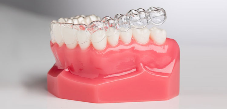 Топ причин выбирать элайнеры с учётом стоимости установки и комфорта